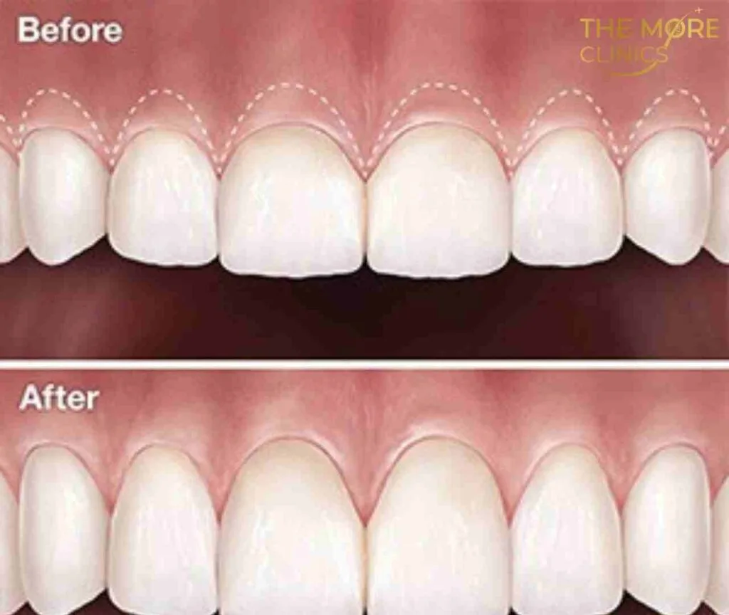 crown lenghtening before and after