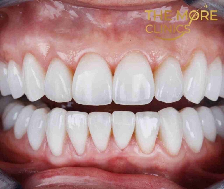 perfekt eingesetzte Zahnkrone zur Vorbeugung von Zahnkronenschmerzen