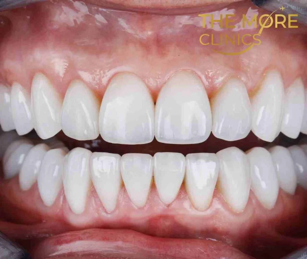 prpper placement to prevent tooth sensitivity after crown and possible dental crown pain