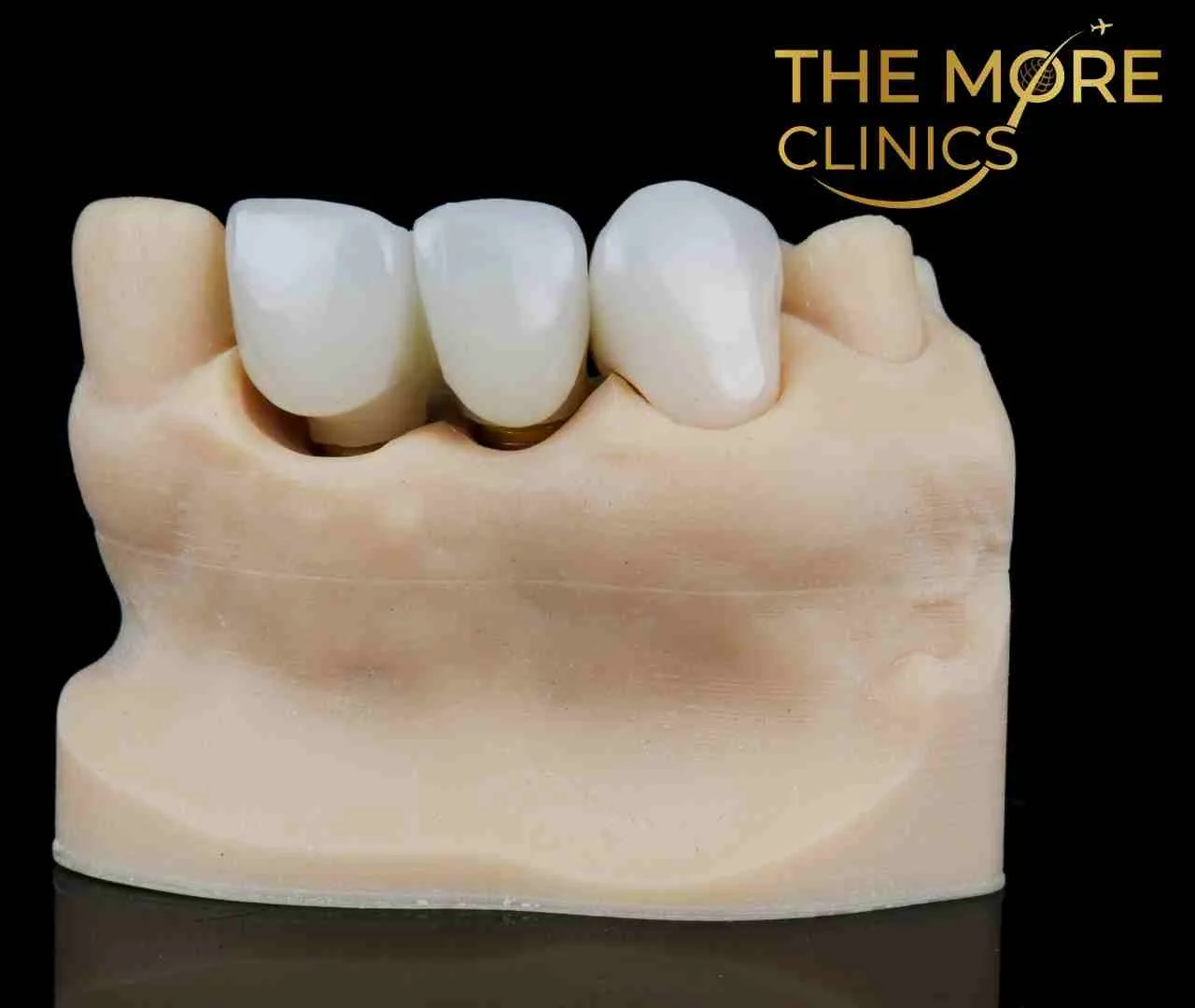 Poorly fitted dental crown can cause crown pain and gum irritation crowned tooth