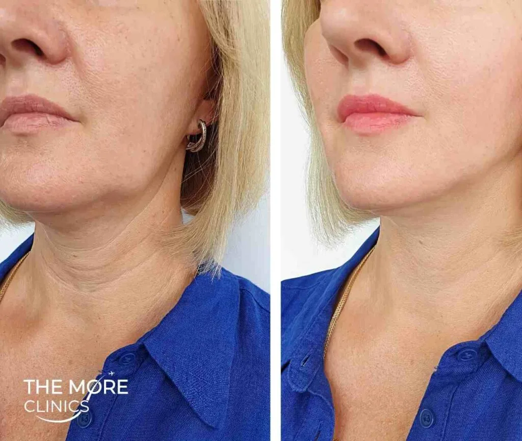 2 stitch mini facelift before and after