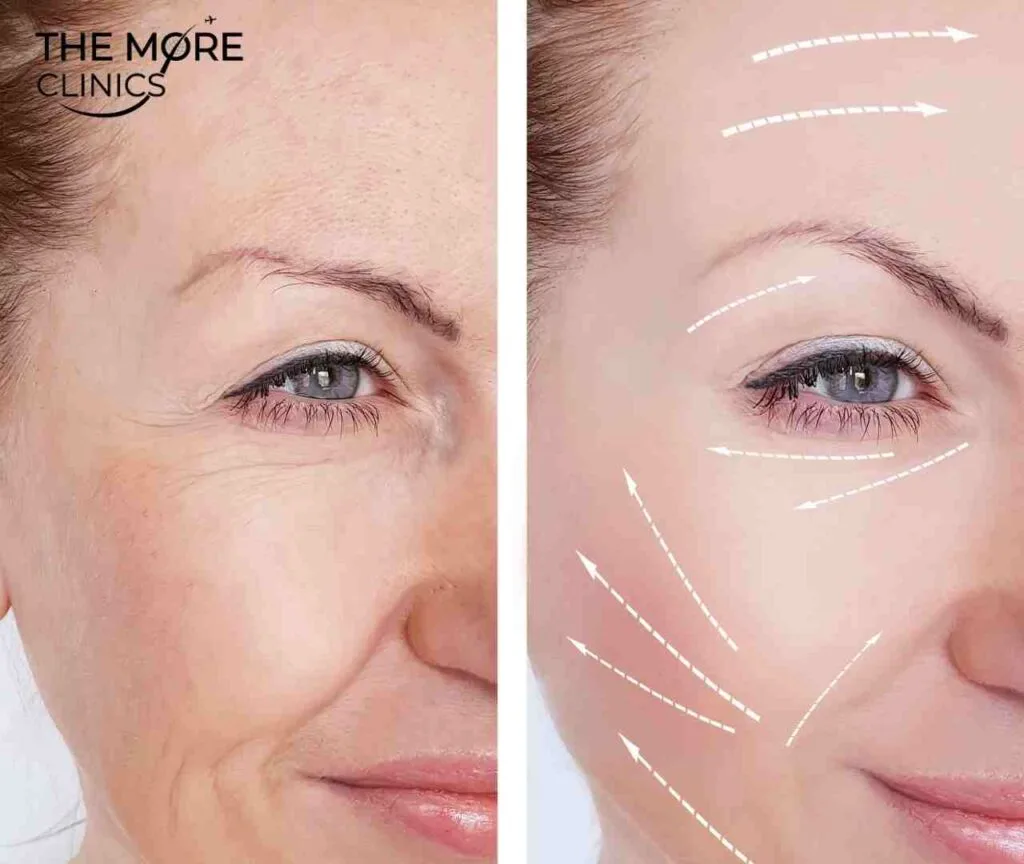 vertical restore before and after facelift turkey