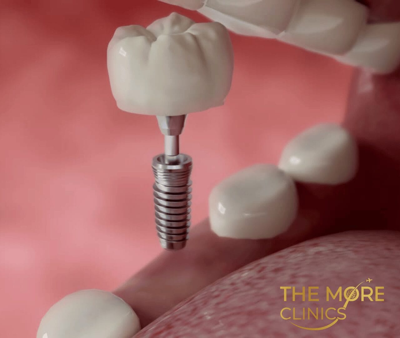 Kosten Zahnimplantat