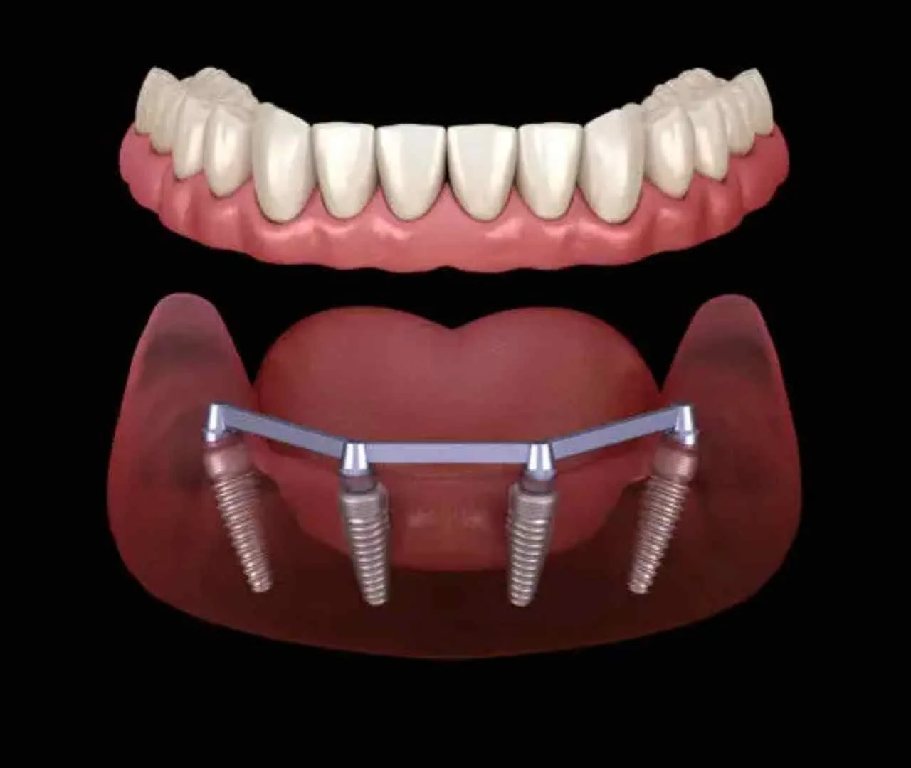 all on 4 full mouth dental implant turkey cost