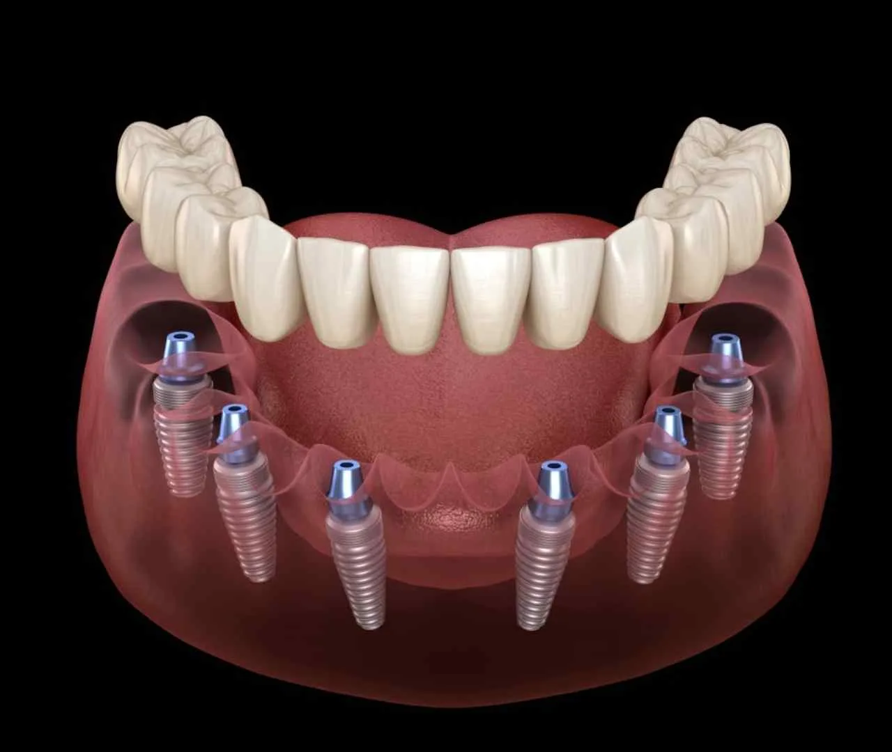 all on 6 full set of dental implants cost turkey