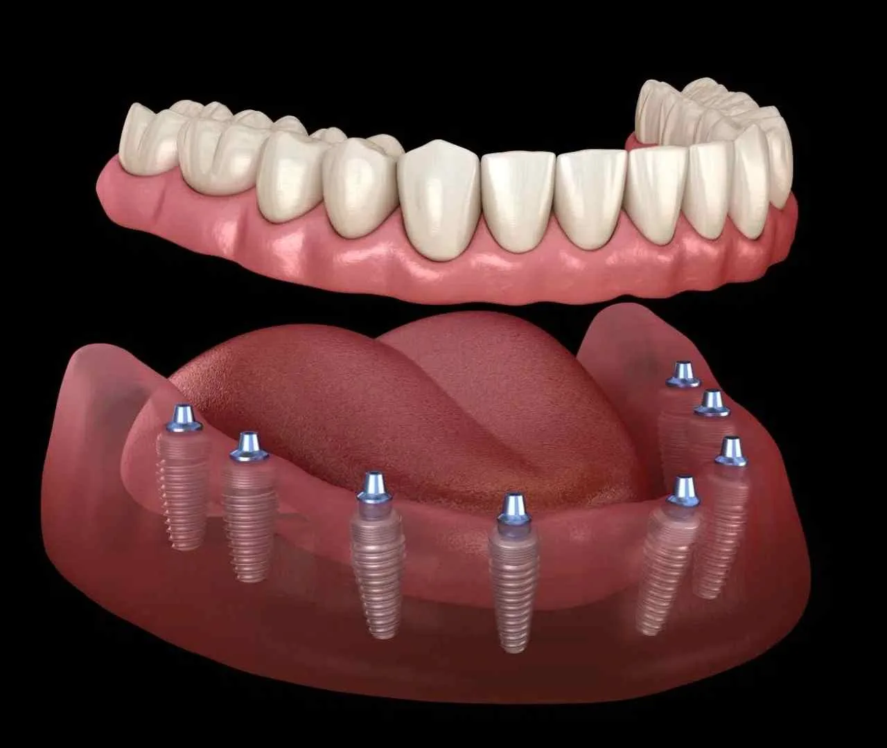 all on 8 full mouth dental implants turkey package deals