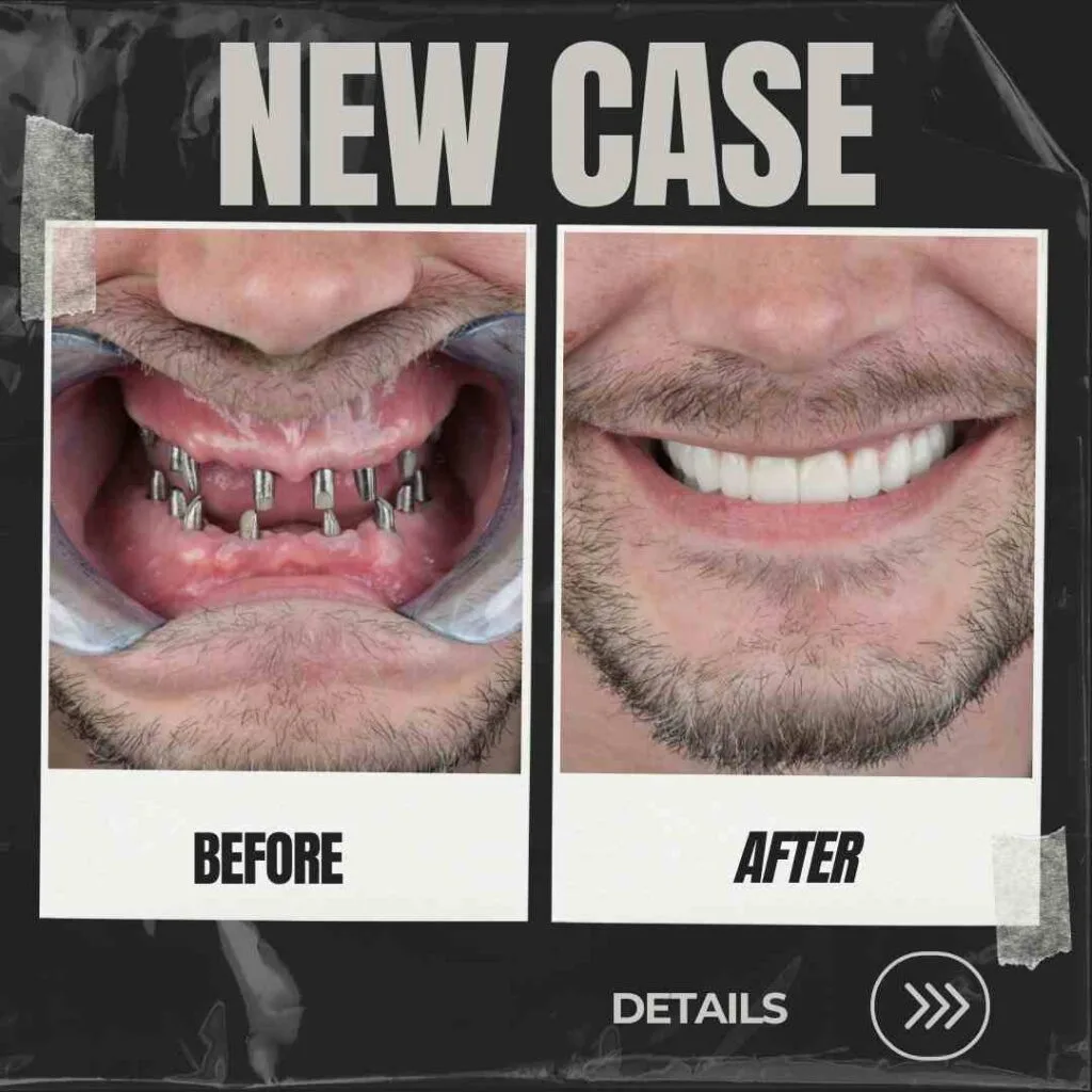 Full mouth dental implants in Turkey package deals and reviews at the best price
