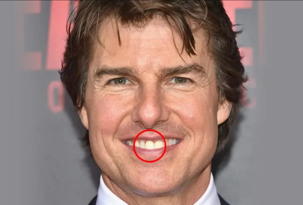 tom cruise teeth midline problem