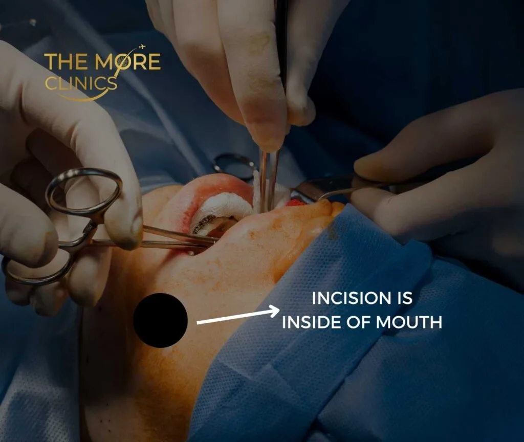 bichectomy buccal fat removal procedure of surgery turkey