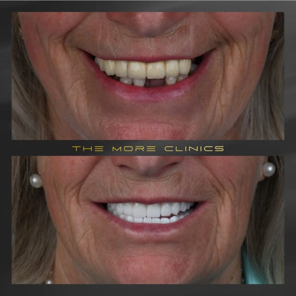 full mouth dental implants abroad helvetic clinics cost vs turkey