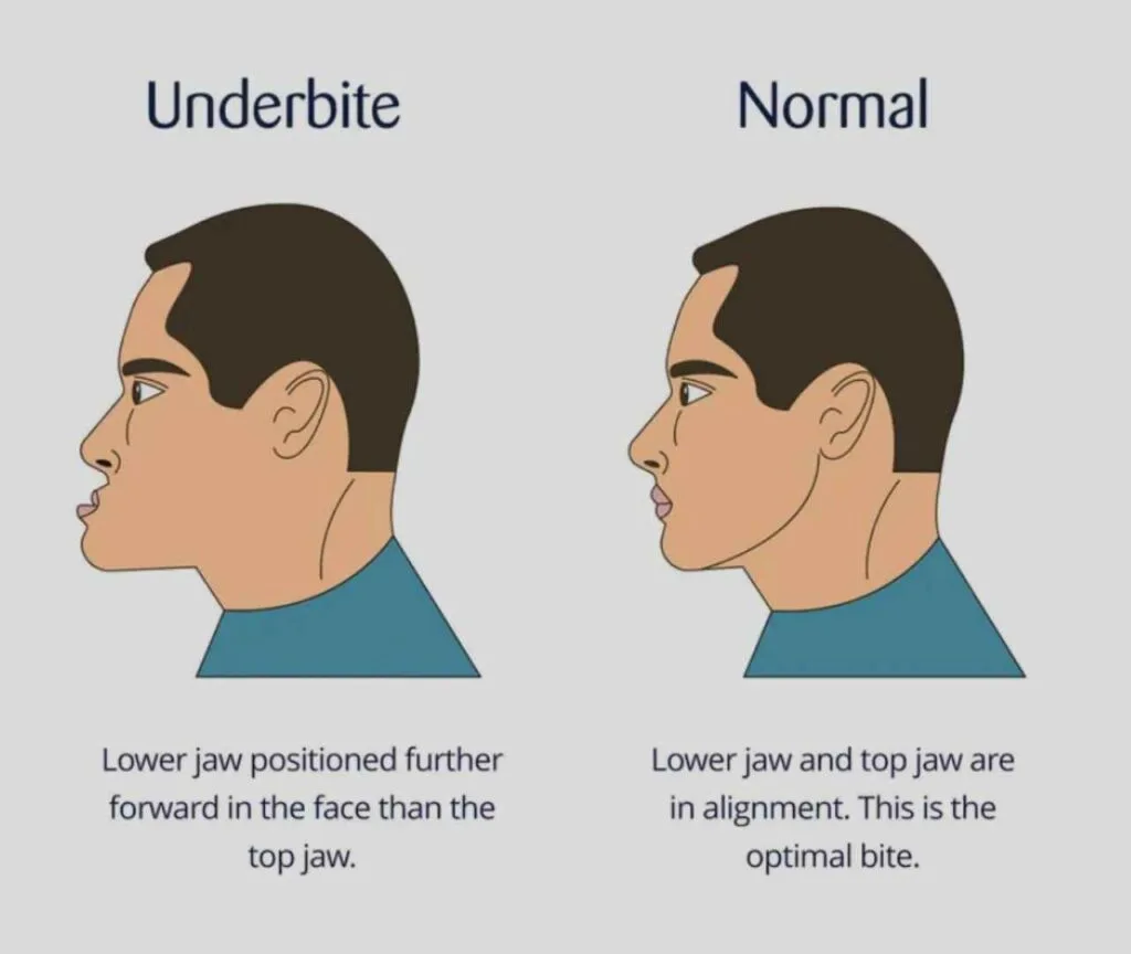 how to fix underbite to normal bite