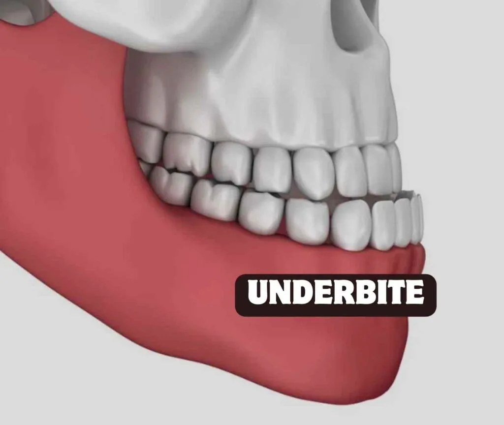 how underbite looks like