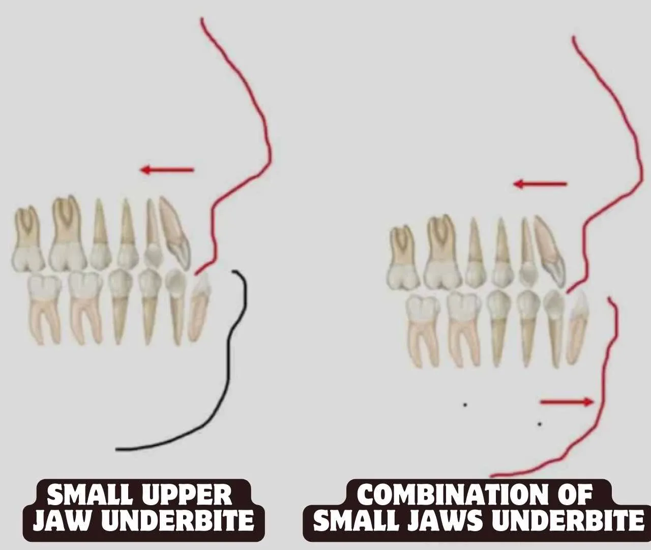 small upper jaw caused underbite how to fix