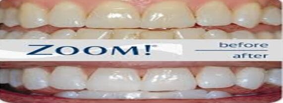 Philips Zoom Dental whitening