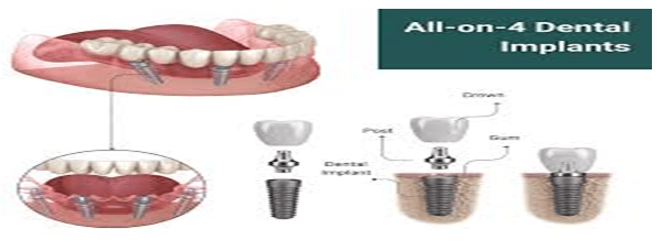 all on 4 dental implants