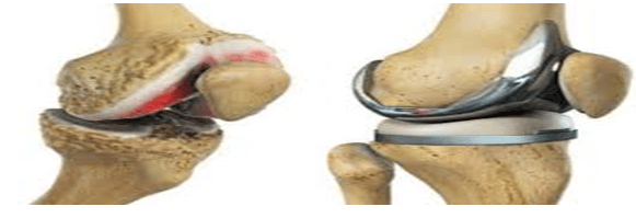 cost of knee replacement surgery in pakistan