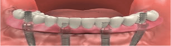 dental implant cost whole mouth