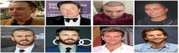 hair transplant famous actors
