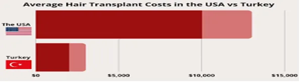 how much does it cost for hair transplant in usa