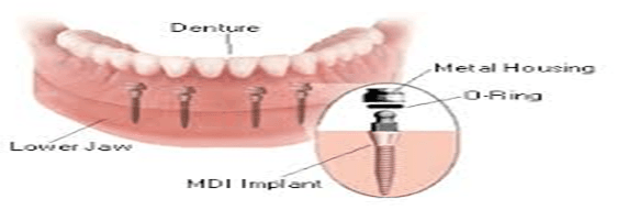 how much is a full set of dental implants uk