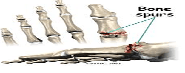 how to get hallux rigidus toe to fuse wihout surgery