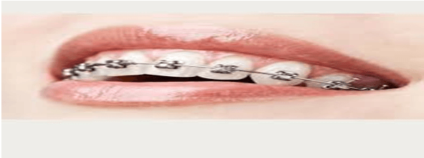 London Orthodontics & Braces: Your Resource for a Straighter, Healthier Smile from ODL Dental Clinic