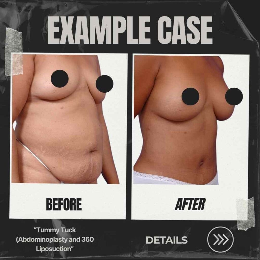 reverse tummy tuck before after