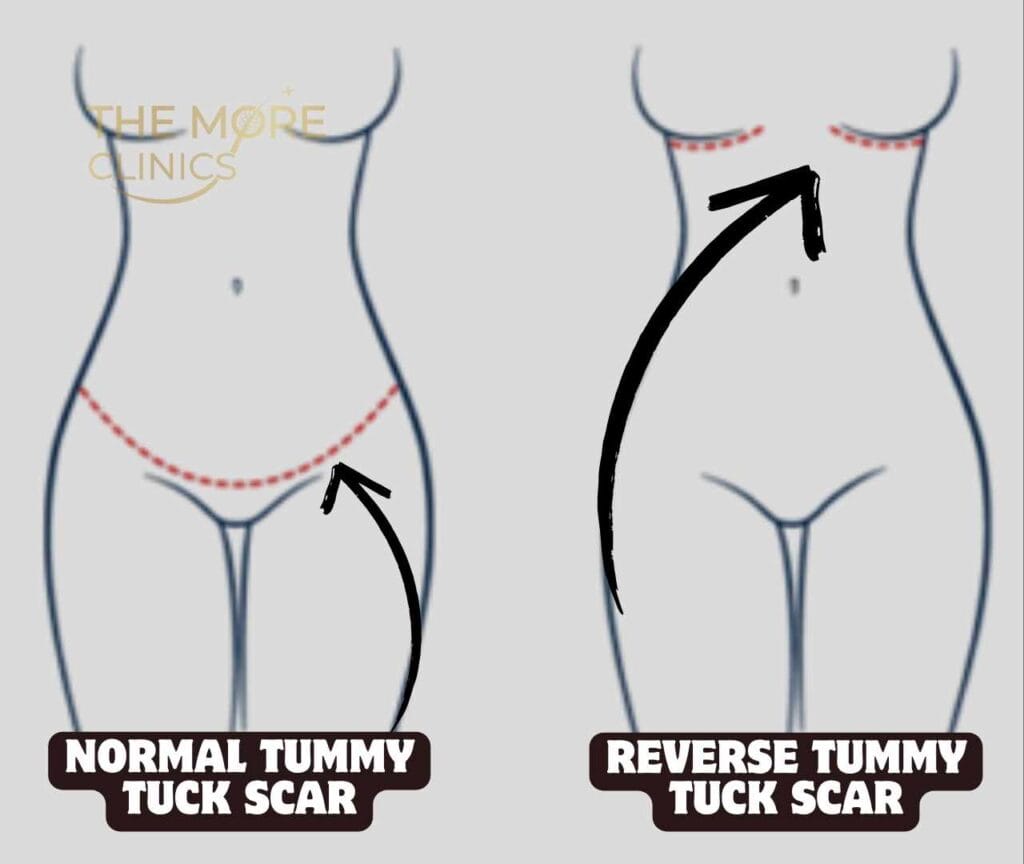 reverse tummy tuck scar vs normal tummy tuck scars