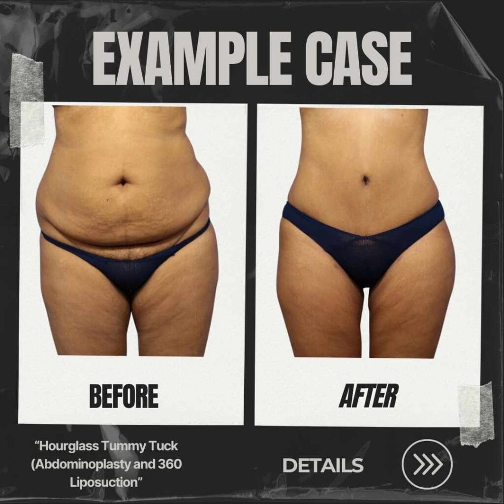 turkey reverse tummy tuck before and after