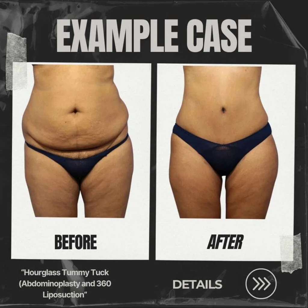 abdominoplastie inversée de la dinde avant et après