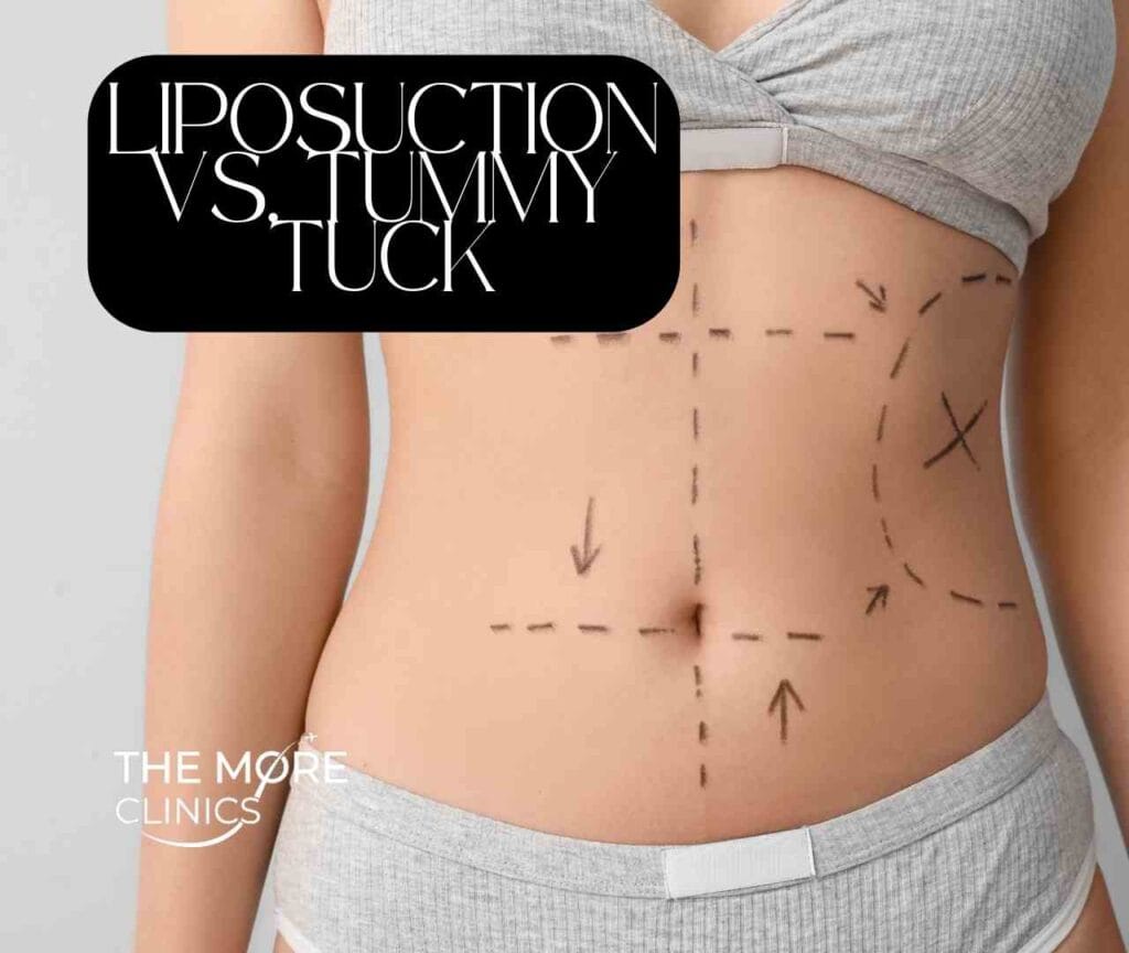 liposuction vs tummy tuck lipo abdominoplasty