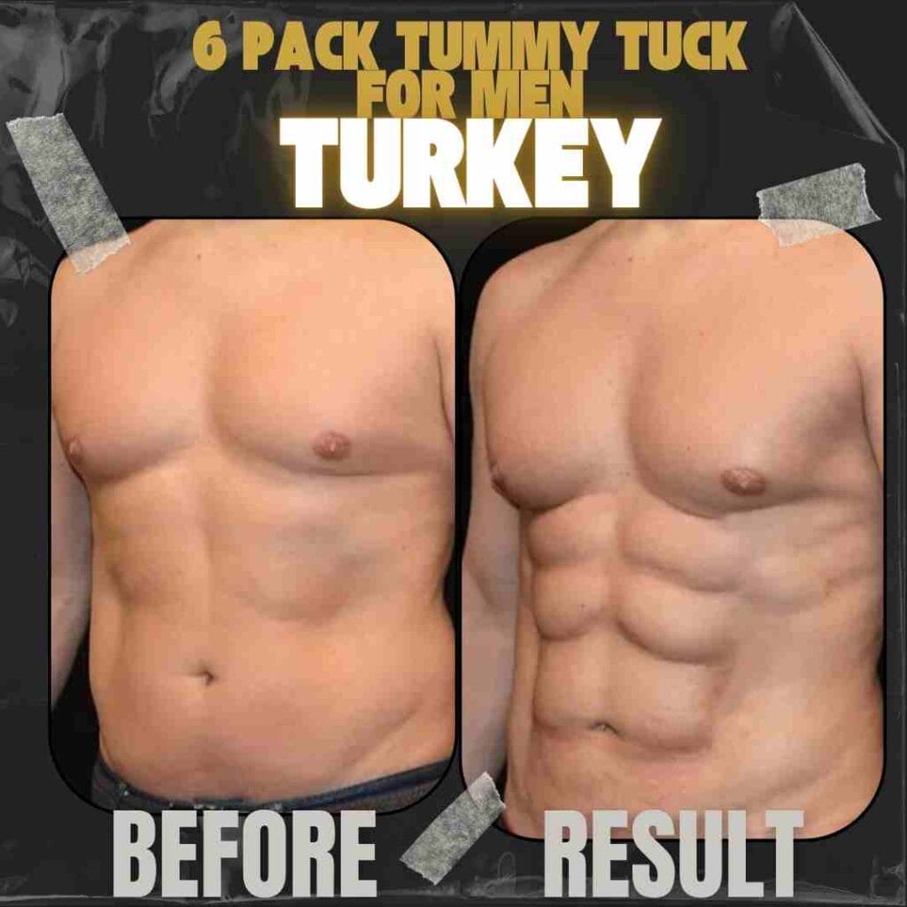 male abdominoplasty tummy tuck before after six pack surgery