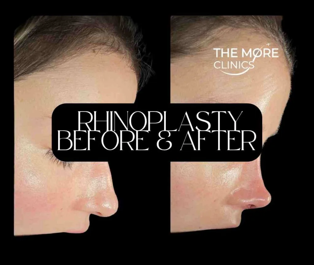 revision wide nose rhinoplasty before and after turkey female