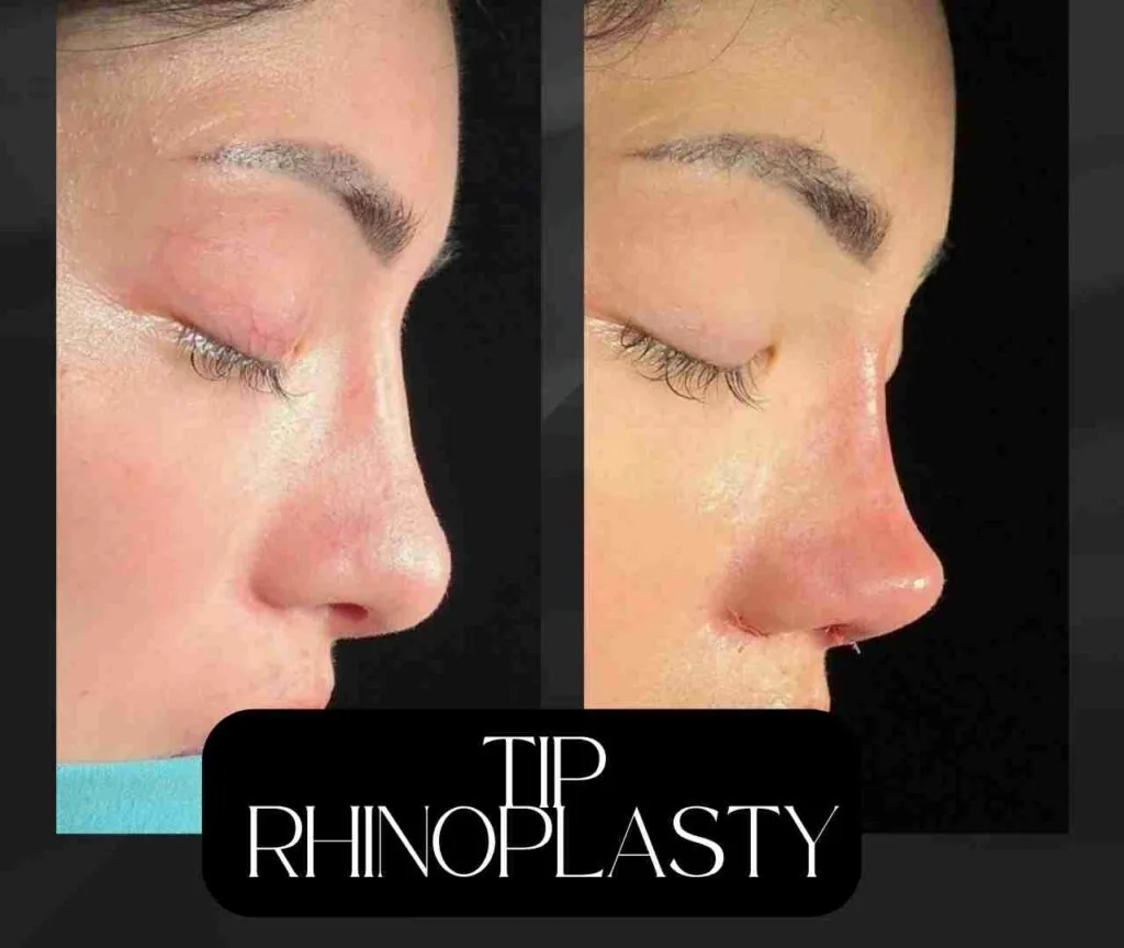 tipi rhinoplasty before after female turkey