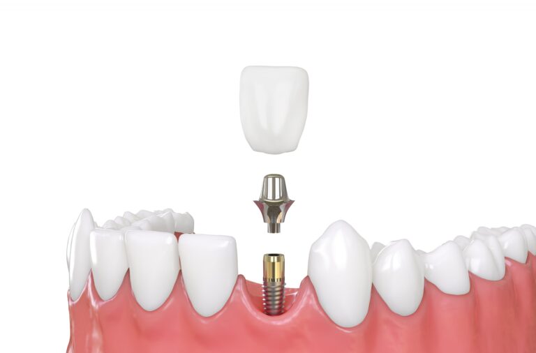 Dental Implants All on 4