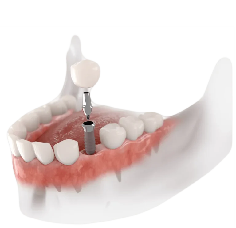 Best Dental Implants in Turkey