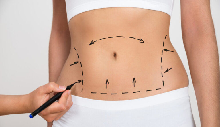Tummy Tuck in Turkey