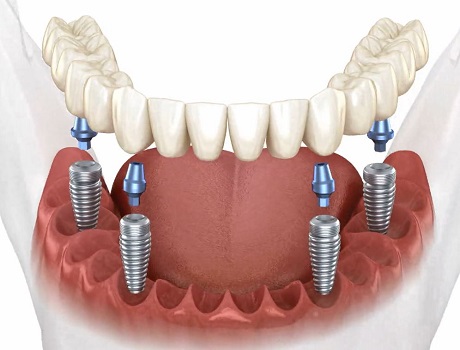 How Much Does Full Mouth Dental Implants Cost