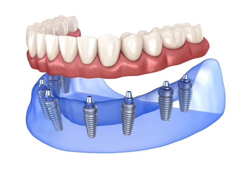 Full Set of Teeth Implants Cost Turkey