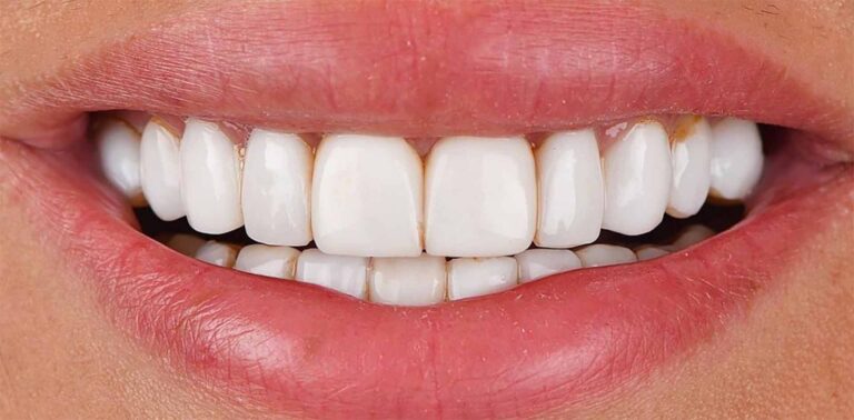 Composite Bonding Turkey