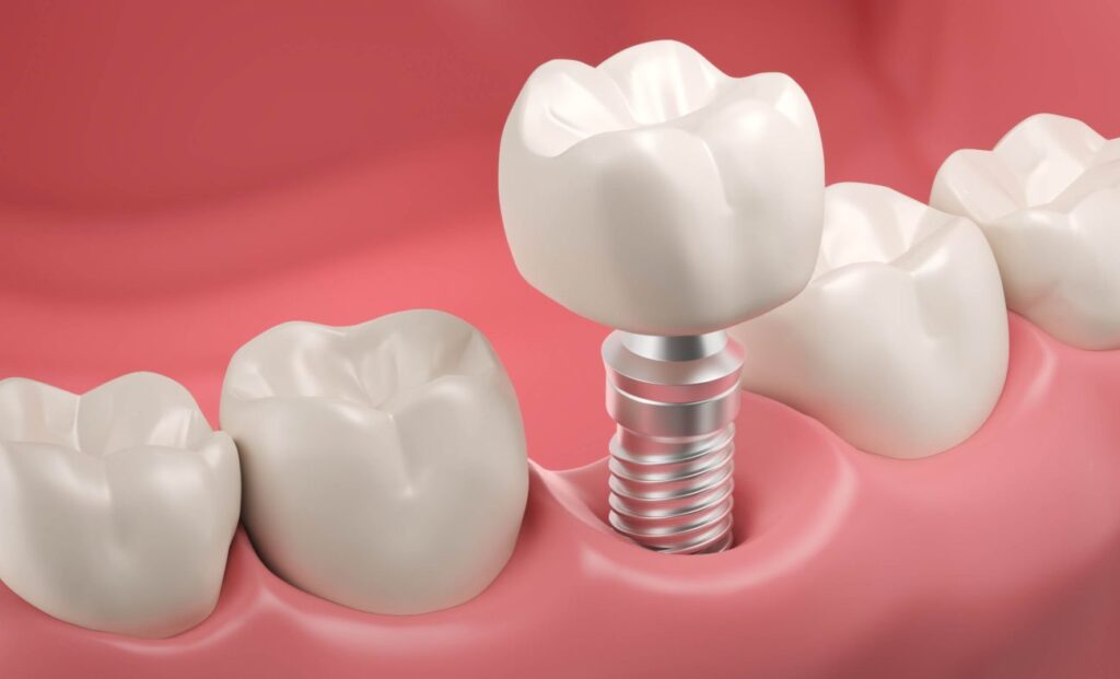 Zahnimplantat Türkei Kosten