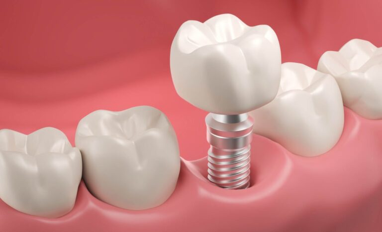 Zahnimplantat Türkei Kosten