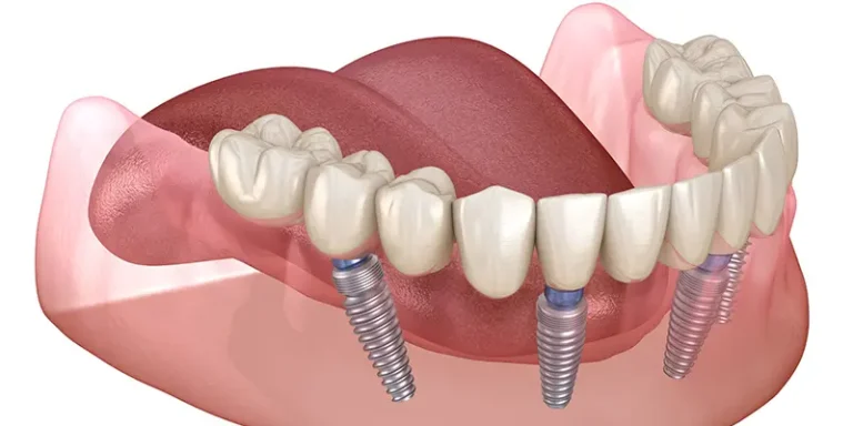 Implant Teeth Turkey Cost