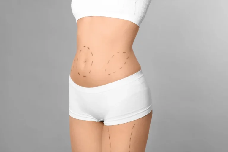 Tummy Tuck Before After in Turkey