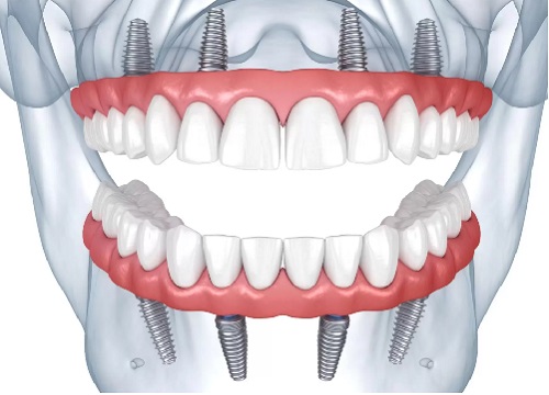 All on 4 dental implants before and after